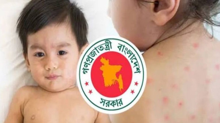 হামের উপসর্গে আরও ২ শিশুর মৃত্যু, হাসপাতালে ভর্তি ১,২৫৭