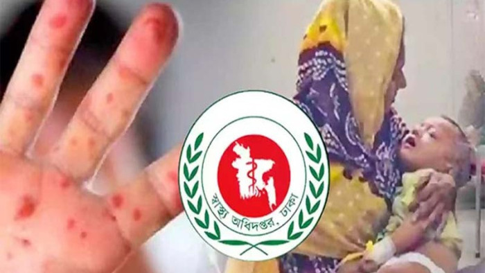 হামের উপসর্গে একদিনে ১১ শিশুর মৃত্যু, আক্রান্ত ১,২৭০