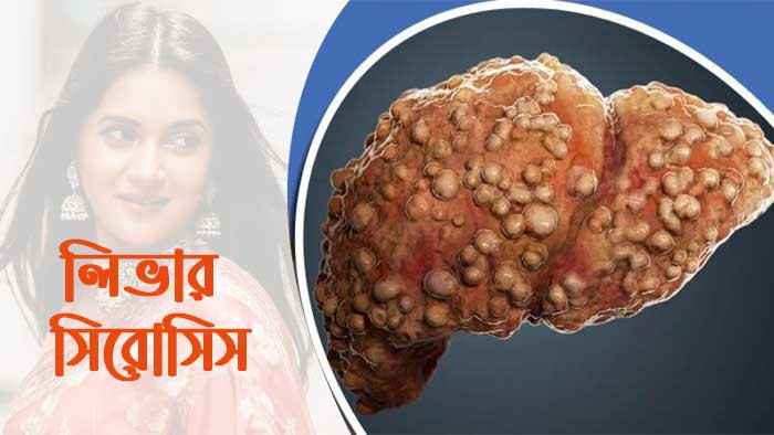 লিভার সিরোসিসে ইবি শিক্ষার্থীর মৃত্যু