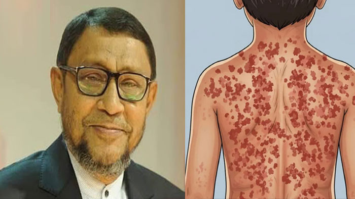 হামের প্রাদুর্ভাব: ৬ কারণে মন্ত্রণালয়ে জরুরি সিরিজ মিটিং